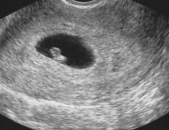 black and white photo of baby sonogram